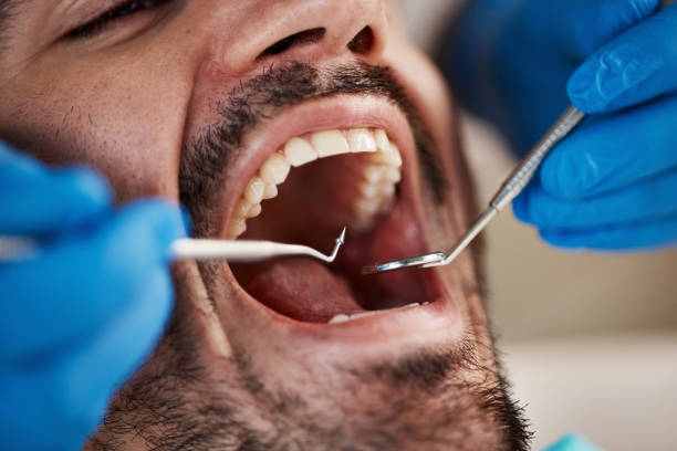 Best Emergency Tooth Extraction in Whitemarsh Island, GA
